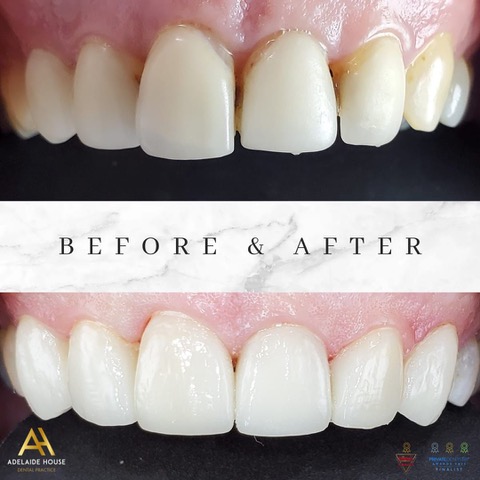 Composite Bonding Bedford