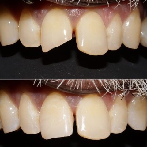 Composite Bonding Bedford